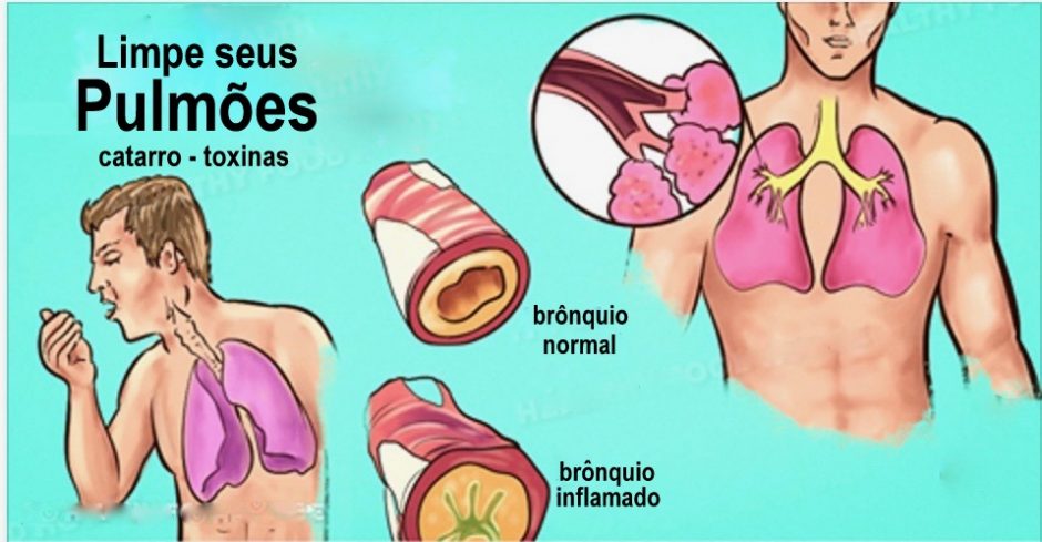 COMO SE LIVRAR NATURALMENTE DO CATARRO NO TÓRAX E GARGANTA - RESULTADO ...