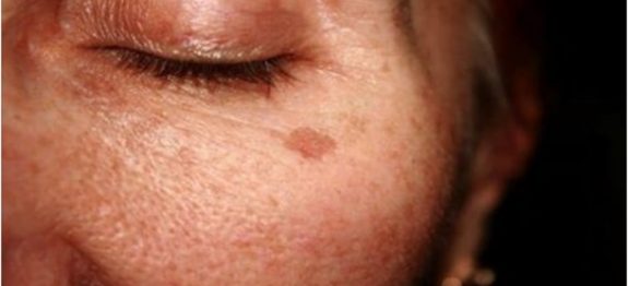 manchas_na_pele_-_novo-610×300