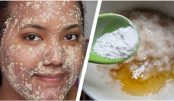 melasma