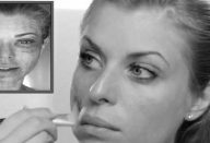 processo-estetico-deixa-hematomas-em-modelo_1440873