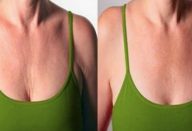 rugas_-_pescoco_e_seios_0-610×300