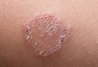 tinha_-_tinea-610×300