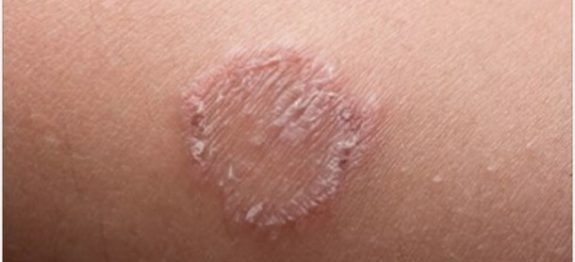 tinha_-_tinea-610×300