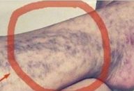 varizes_-_tomate_-_novo