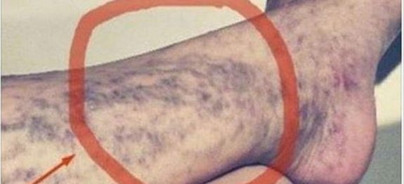 varizes_-_tomate_-_novo