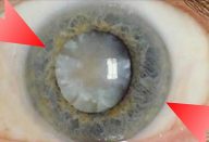 Tratamento natural para catarata – Aprenda Como Fazer em Casa!