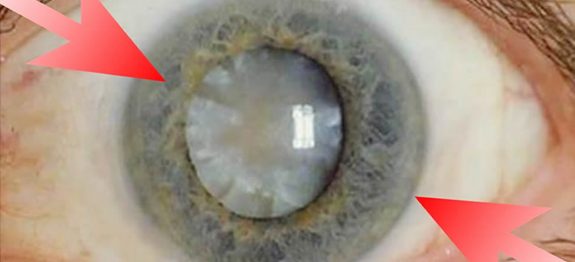Tratamento natural para catarata – Aprenda Como Fazer em Casa!