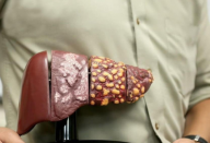 8 sinais que indicam que uma pessoa têm câncer de fígado