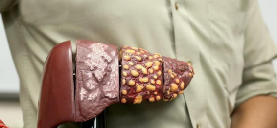 8 sinais que indicam que uma pessoa têm câncer de fígado