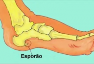 Esporão, você não vai sofrer mais… Com estes três maravilhosos tratamentos, você não sofrerá mais com a dor no calcanhar.. Ver mais
