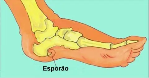 Esporão, você não vai sofrer mais… Com estes três maravilhosos tratamentos, você não sofrerá mais com a dor no calcanhar.. Ver mais