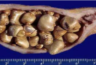 Médico naturalista ensina como eliminar as pedras da vesícula e limpar o fígado gordo.. Ver mais