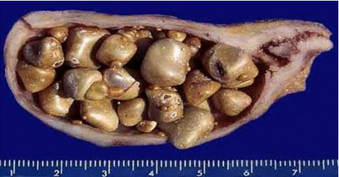 Médico naturalista ensina como eliminar as pedras da vesícula e limpar o fígado gordo.. Ver mais