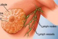 Esta é uma das causas do câncer de mama segundo cientistas. E você a consome quase todos os dias