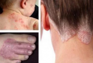 Os melhores remédios naturais para eliminar eczema, psoríase e outras doenças de pele