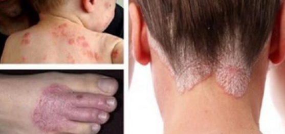 Os melhores remédios naturais para eliminar eczema, psoríase e outras doenças de pele