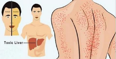 15 avisos que o corpo dá quando o fígado está sendo destruído.