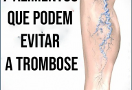 Consuma estes 7 alimentos que podem evitar a trombose.