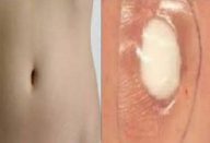 Gripe, tosse ou cólicas menstruais Basta colocar isto no umbigo e está resolvido