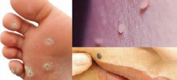 Livre-se de verruga e de olho de peixe EM MENOS DE 48 HORAS com esta receita