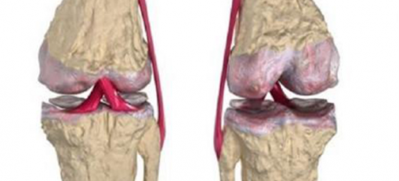 Os melhores remédios naturais para a regeneração da cartilagem do quadril e dos joelhos