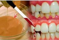 dentes