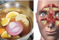ESTA É A “BOMBA” CONTRA A CONGESTÃO NASAL E A GRIPE – VAI CURAR VOCÊ EM 24 HORAS!