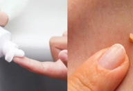 Remédio caseiro com 3 ingredientes que é tiro e queda contra verrugas