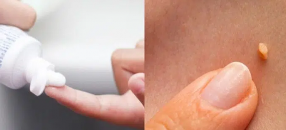 Remédio caseiro com 3 ingredientes que é tiro e queda contra verrugas