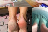 Receitas caseiras para pés rachados com ingredientes que tem no seu armário…Ver mais