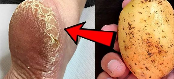 como-minha-mae-acabou-com-as-rachaduras-dos-meus-pes-usando-uma-batata-23-10.jpg